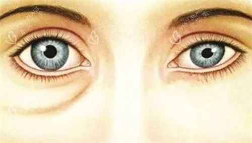 假性眼袋对比展示图 假性眼袋对比展示图