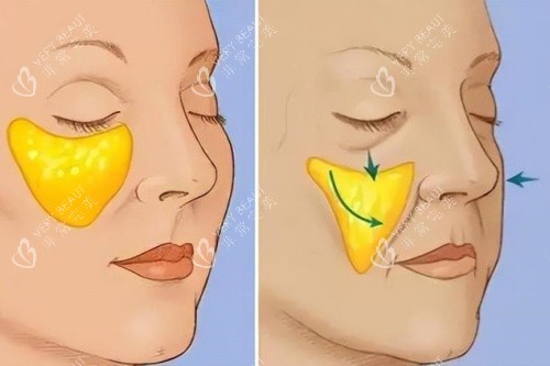 苹果肌下垂于正常苹果肌卡通对比图