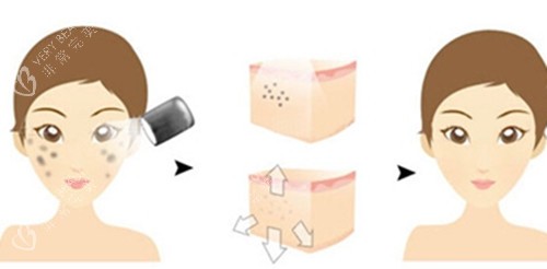 面部激光祛斑前后对比卡通示意图