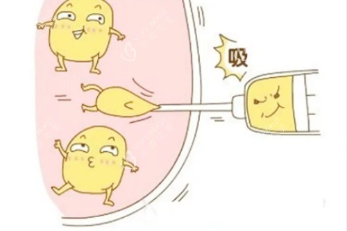 吸脂卡通展示图