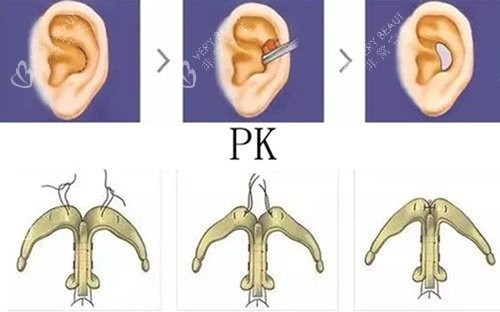耳软骨支架隆鼻图 耳软骨支架隆鼻图