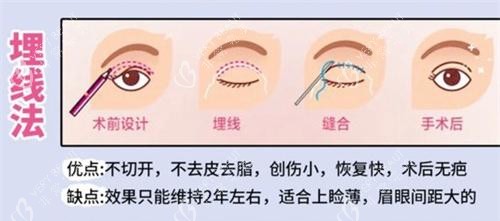 双眼皮手术埋线法动画演示图