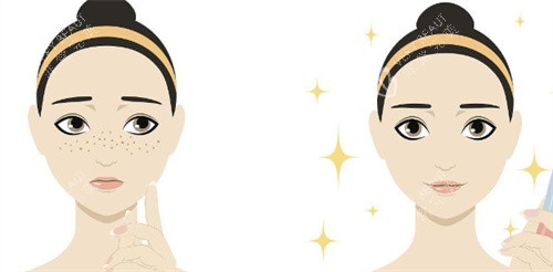 激光祛斑对比示图