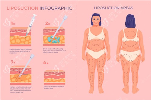 吸脂前后对比照 吸脂前后对比照