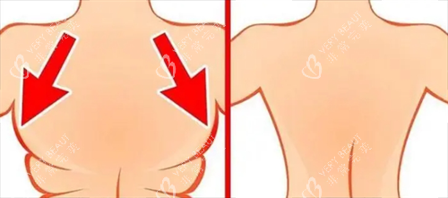 背部吸脂前后动画对比图