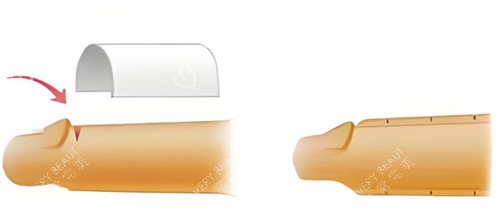 男性增粗手术示意图