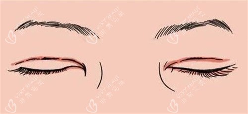 双眼皮疤痕修复