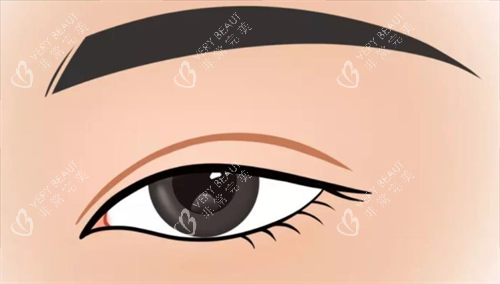 双眼皮形态展示 双眼皮形态展示