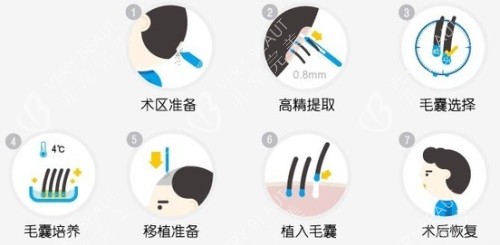 植发过程图解 植发过程图解