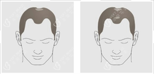 发际线及头顶头发脱落素材 发际线及头顶头发脱落素材