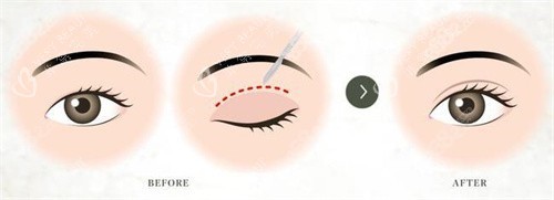 双眼皮术对比宣传图 双眼皮术对比宣传图