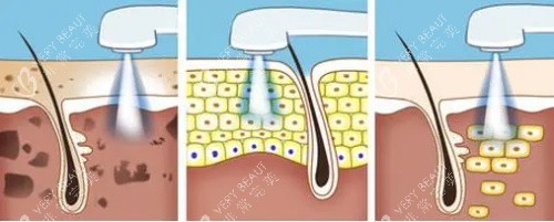 光子嫩肤的过程