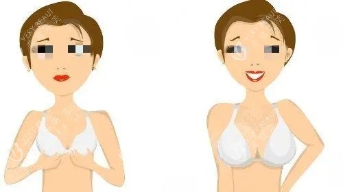 假体隆胸术后示意图