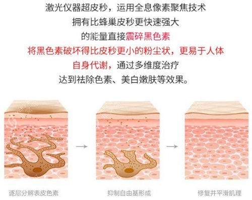 激光祛斑前后的对比