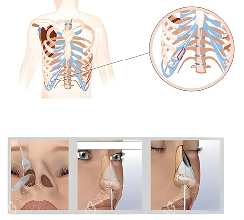 隆鼻肋骨鼻原理图