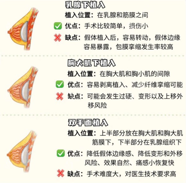 假体隆胸的不同植入位置图解
