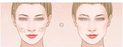 面部填充对比图 面部填充对比图