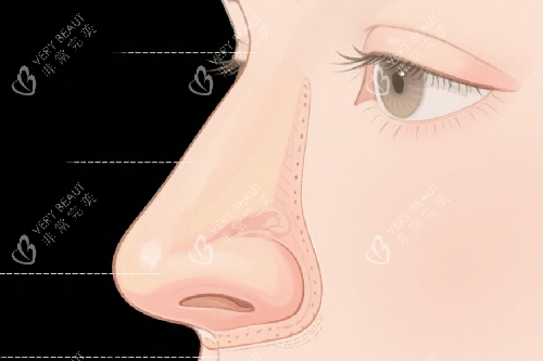 隆鼻示意图 隆鼻示意图