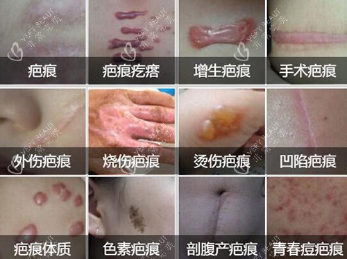 常见的疤痕类型展示图 常见的疤痕类型展示图