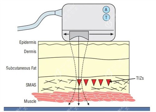 超声炮工作原理 超声炮工作原理
