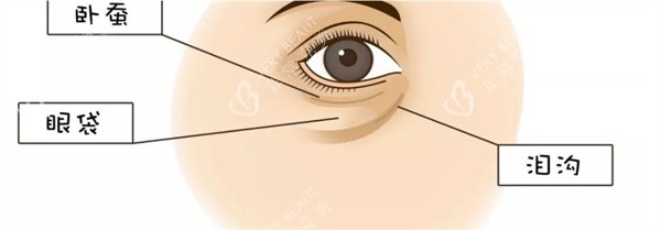 眼部卧蚕眼袋泪沟位置示意图 眼部卧蚕眼袋泪沟位置示意图