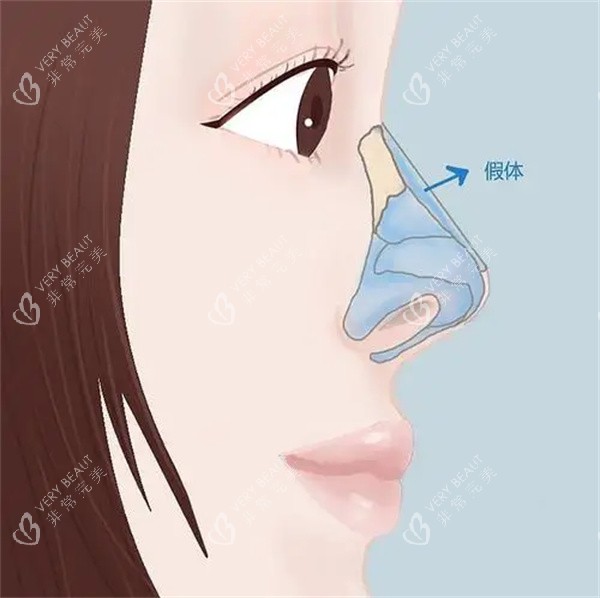 假体隆鼻整形手术 假体隆鼻整形手术