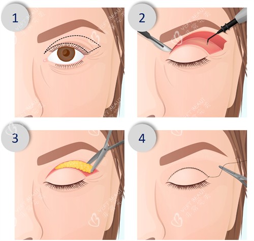 切开型双眼皮手术过程 切开型双眼皮手术过程