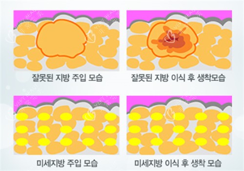 自体脂肪填充术后脂肪细胞前后对比