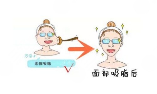 面部吸脂术后示意图 面部吸脂术后示意图