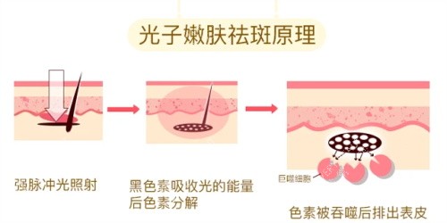 光子嫩肤的祛斑原理