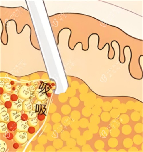 吸脂手术动画 吸脂手术动画