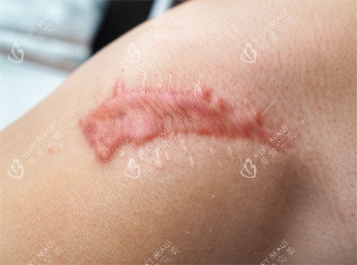 疤痕疙瘩1 疤痕疙瘩1