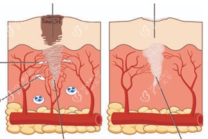 不同情况的疤痕在皮肤上的表现 不同情况的疤痕在皮肤上的表现