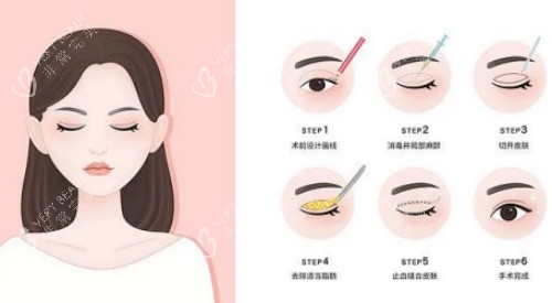 拉双眼皮手术示意图
