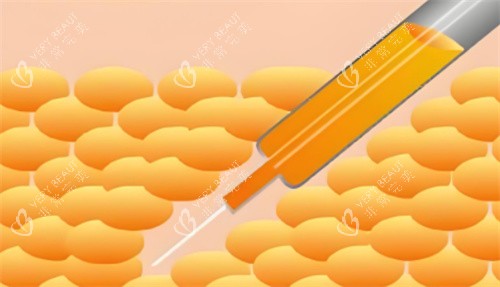吸脂手术图 吸脂手术图