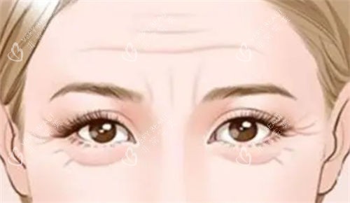 泪沟型眼袋和眼角细纹展示图 泪沟型眼袋和眼角细纹展示图
