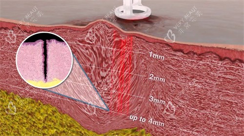 皮肤内的疤痕纹理 皮肤内的疤痕纹理