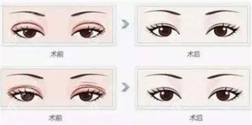 双眼皮修复