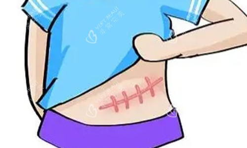 腹部疤痕增生的动画图 腹部疤痕增生的动画图