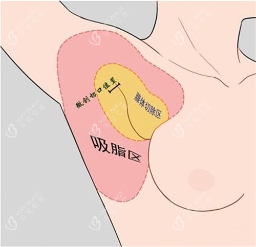 副乳切口位置与吸脂区动画演示图 副乳切口位置与吸脂区动画演示图