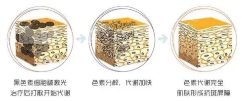 激光祛斑的原理