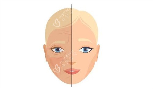 面部除皱对比 面部除皱对比