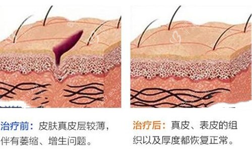 激光祛疤前后对比示意图
