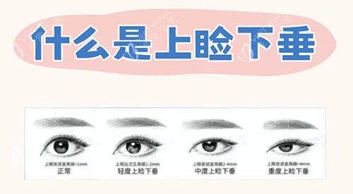 什么是上睑下垂