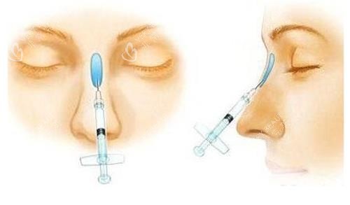液态隆鼻示意图
