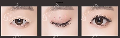 埋線雙眼皮過(guò)程示意圖