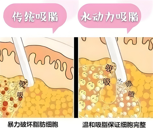 负压吸脂和水动力吸脂方式对比动画图