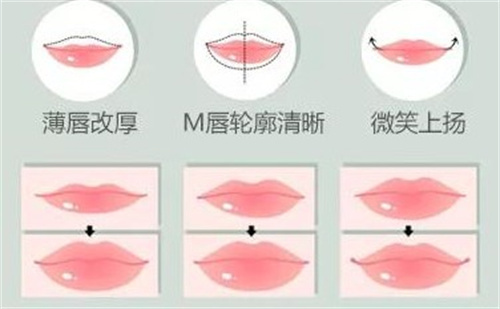 嘴唇整形手术