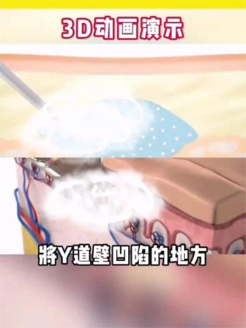 紧缩针注射阴道动画图