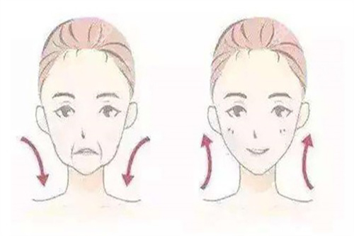 拉皮面部提升对比卡通示意图